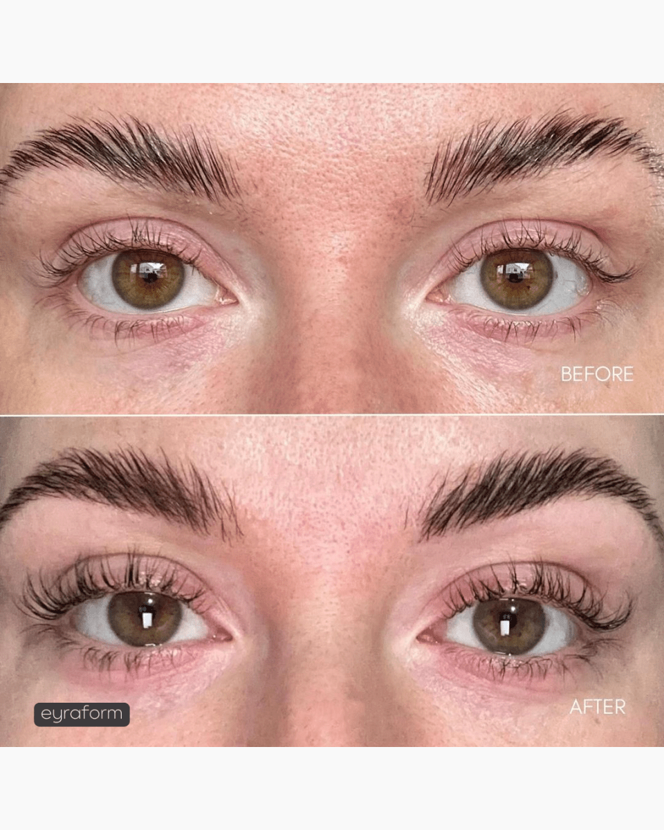 Before after EYRĀ